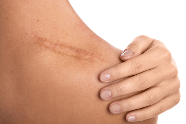 Best Scar Removal Treatment in Pimpri Chinchwad, by Dr Padmawar